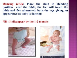 Dancing reflex: Place the child in standing
position near the table, the feet will touch the
table and flex alternately both the legs giving an
appearance as baby is dancing.
NB : It disappear by the 1-2 months
 