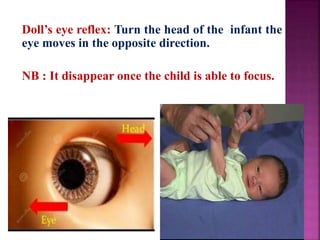 Doll’s eye reflex: Turn the head of the infant the
eye moves in the opposite direction.
NB : It disappear once the child is able to focus.
 