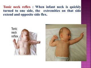 Tonic neck reflex : When infant neck is quickly
turned to one side, the extremities on that side
extend and opposite side flex.
 