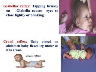 Glabellar reflex: Tapping briskly
on Glabella causes eyes to
close tightly or blinking.
Crawl reflex: Baby placed on
abdomen baby flexes leg under as
if to crawl.
 
