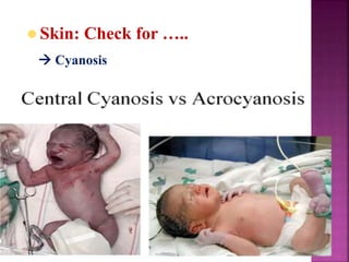  Cyanosis
 Skin: Check for …..
 