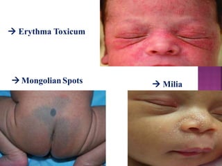  Erythma Toxicum
 Milia Mongolian Spots
 