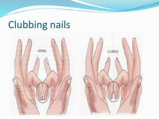 Nail Clubbing Algorithm health assessment theory cardiovascular and abdomin.pdf