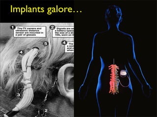 Implants galore…
 