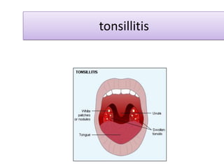 tonsillitis