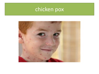 chicken pox