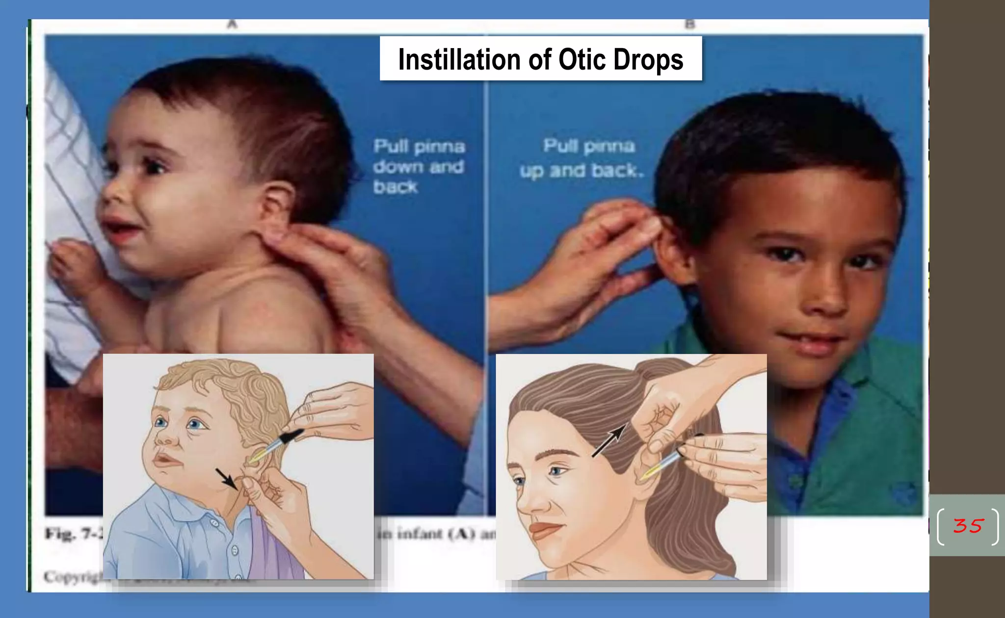35
Instillation of Otic Drops
 