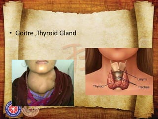 • Goitre ,Thyroid Gland
 