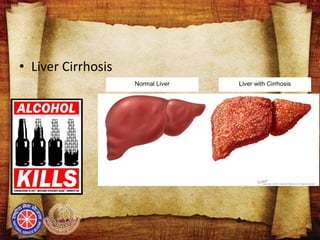 • Liver Cirrhosis
 