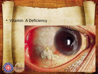 • Vitamin A Deficiency
 