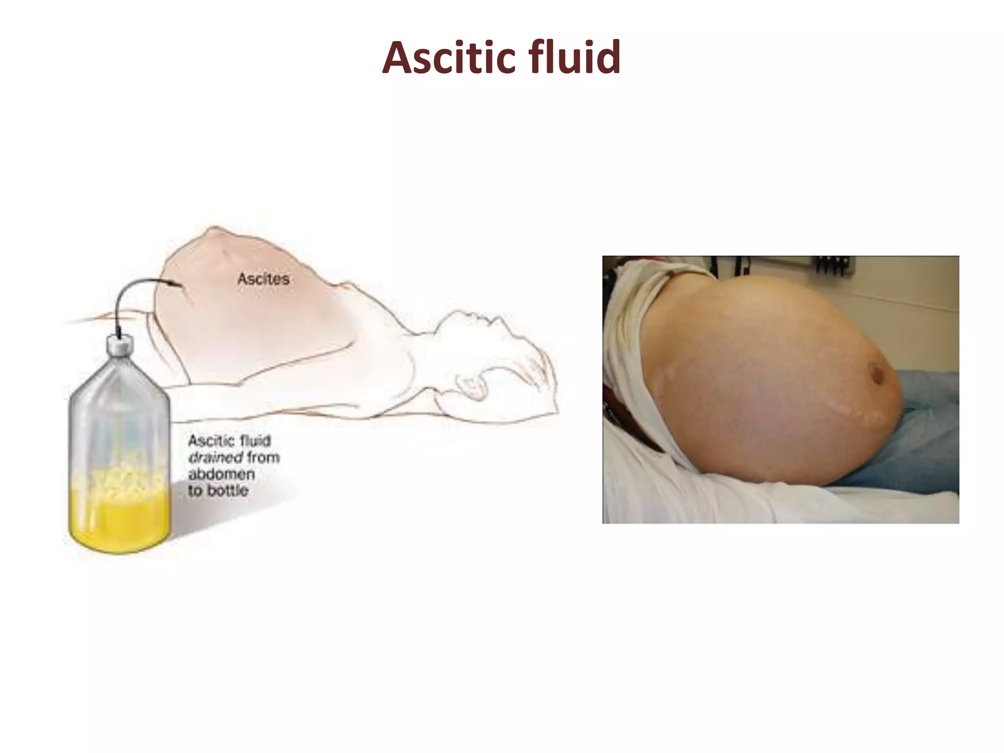 Ascitic fluid 
 