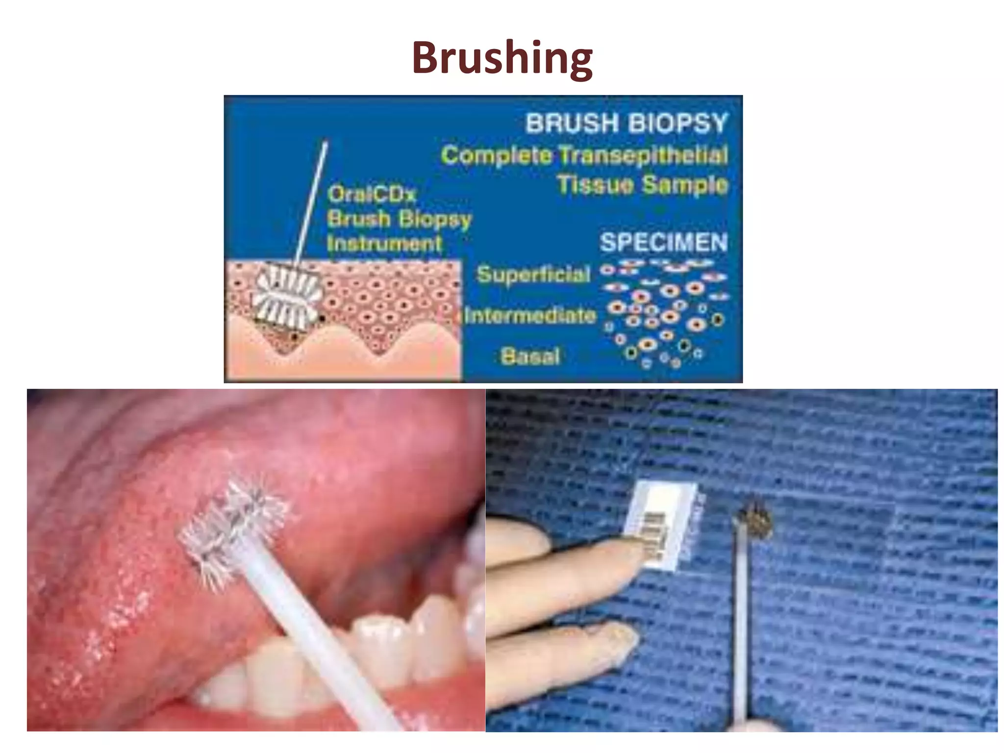 Brushing 
 