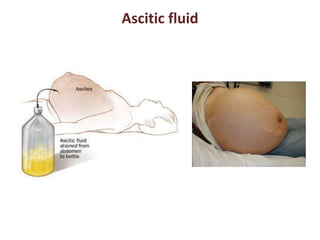 Ascitic fluid 
 