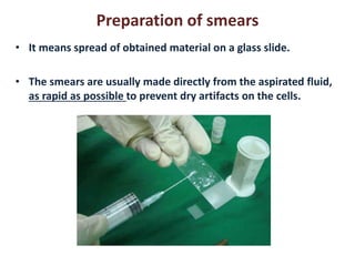 Preparation of smears 
• It means spread of obtained material on a glass slide. 
• The smears are usually made directly from the aspirated fluid, 
as rapid as possible to prevent dry artifacts on the cells. 
 