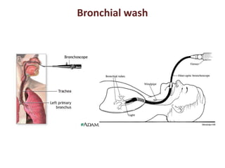 Bronchial wash 
 
