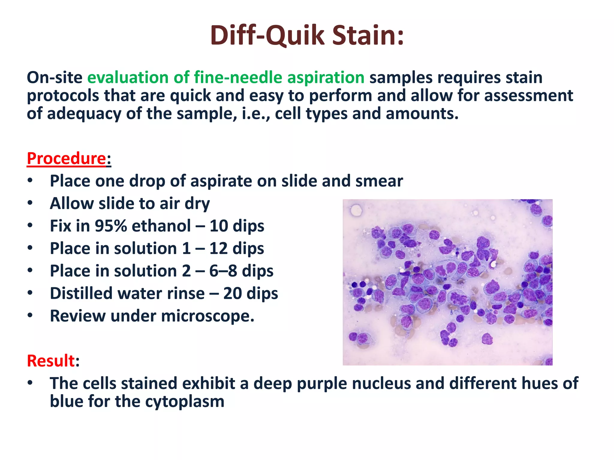 Diff-Quik Stain: 
On-site evaluation of fine-needle aspiration samples requires stain protocols that are quick and easy to perform and allow for assessment of adequacy of the sample, i.e., cell types and amounts. 
Procedure: 
•Place one drop of aspirate on slide and smear 
•Allow slide to air dry 
•Fix in 95% ethanol – 10 dips 
•Place in solution 1 – 12 dips 
•Place in solution 2 – 6–8 dips 
•Distilled water rinse – 20 dips 
•Review under microscope. 
Result: 
•The cells stained exhibit a deep purple nucleus and different hues of blue for the cytoplasm  