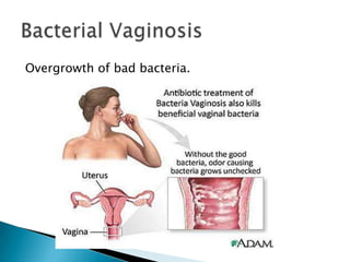Overgrowth of bad bacteria.