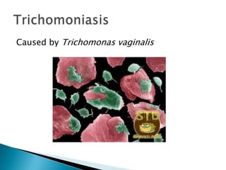 Caused by Trichomonas vaginalis