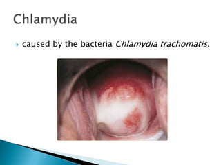  caused by the bacteria Chlamydia trachomatis.