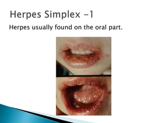 Herpes usually found on the oral part.