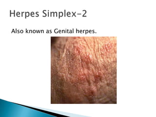 Also known as Genital herpes.