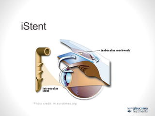 Canaloplasty New Glaucoma Treatment – HealthTalk at San Gabriel Valley ...