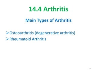 14.4 Arthritis
Main Types of Arthritis
Osteoarthritis (degenerative arthritis)
Rheumatoid Arthritis
319
 