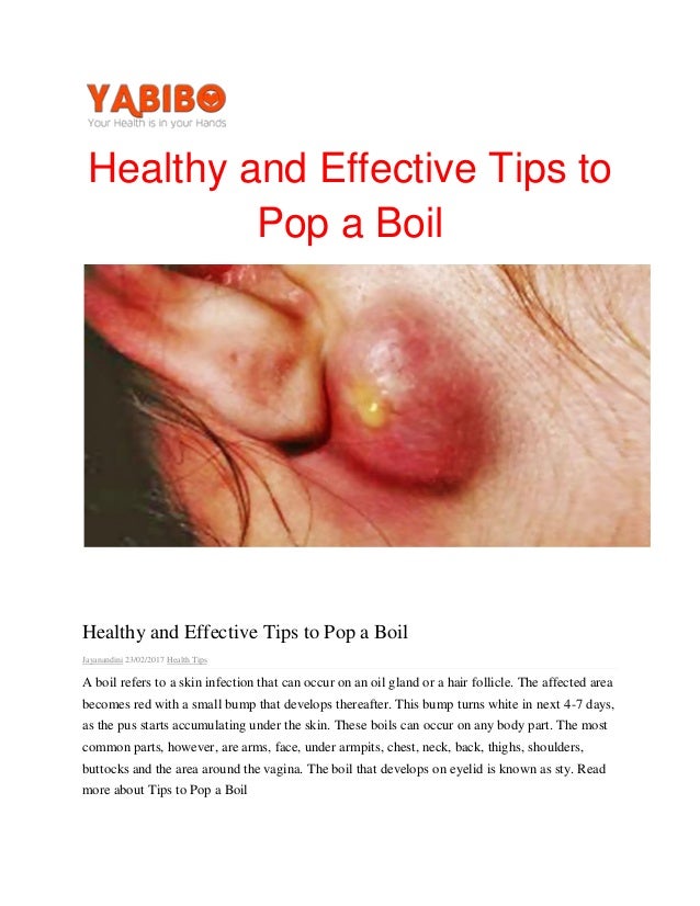 Healthy and effective tips to pop a boil