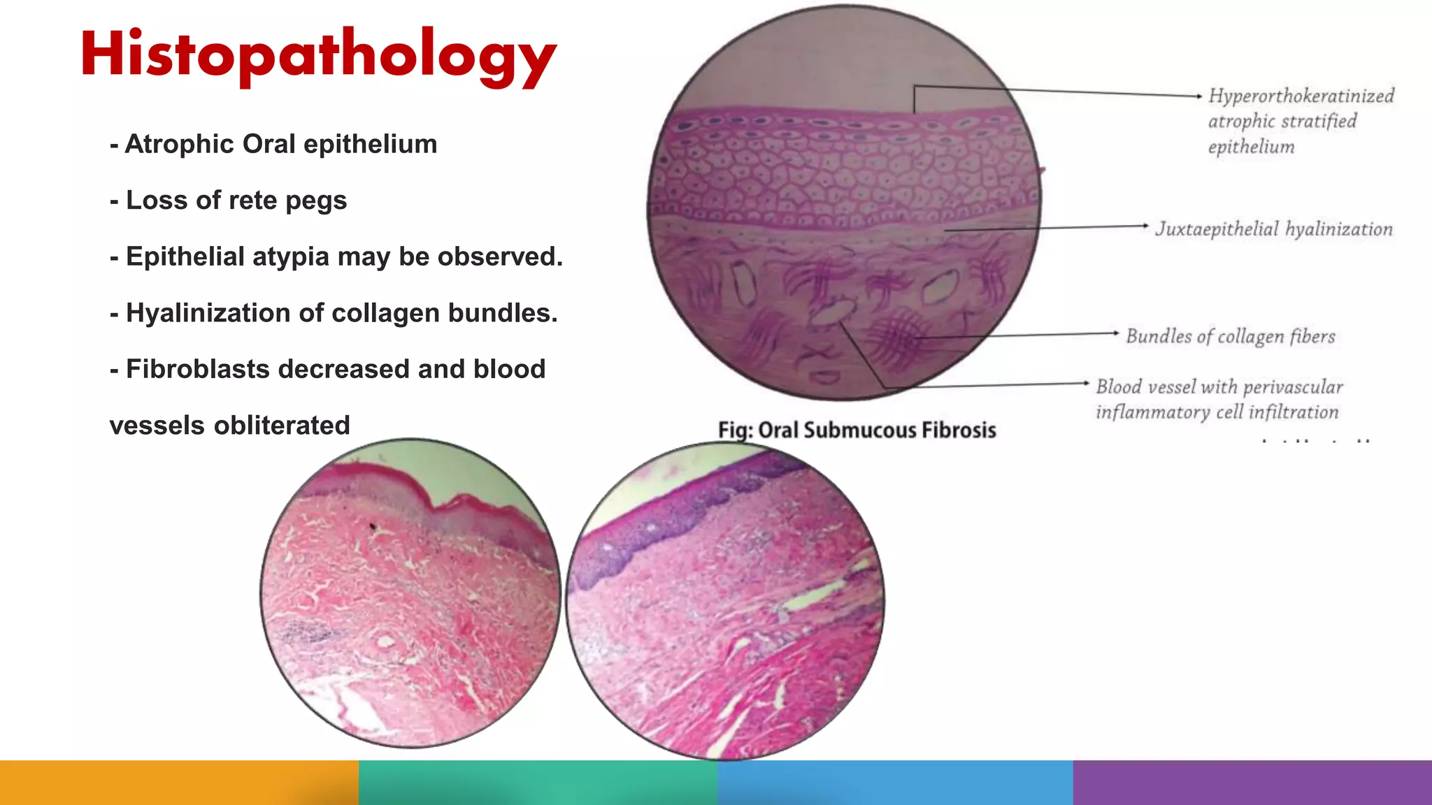 ORAL SUBMUCOUS FIBROSIS MULTI | PPTX