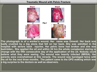 The photograph is of a worker’s wound. Her name was Omwati. Her back was
badly crushed by a big stone that fell on her back. She was admitted in the
hospital with severe back injuries. Her pelvic bone had broken and she was
bedridden.. She applied the oil and within 24 hrs the whole complexion staring to
change with the fifth consecutive day of the application of the oil. Nobody could
believe what they were seeing. The wound was heavily infected (MRSA). Her
parents were overwhelmed at this miracle. The wound was bandaged twice with
the oil for the next three months. The patient came to the OPD walking which was
a big surprise to the doctors as well as observers.
Traumatic Wound with Pelvic Fracture
 