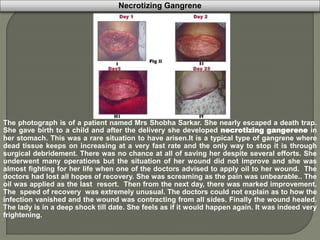 Necrotizing Gangrene
The photograph is of a patient named Mrs Shobha Sarkar. She nearly escaped a death trap.
She gave birth to a child and after the delivery she developed necrotizing gangerene in
her stomach. This was a rare situation to have arisen.It is a typical type of gangrene where
dead tissue keeps on increasing at a very fast rate and the only way to stop it is through
surgical debridement. There was no chance at all of saving her despite several efforts. She
underwent many operations but the situation of her wound did not improve and she was
almost fighting for her life when one of the doctors advised to apply oil to her wound. The
doctors had lost all hopes of recovery. She was screaming as the pain was unbearable.. The
oil was applied as the last resort. Then from the next day, there was marked improvement.
The speed of recovery was extremely unusual. The doctors could not explain as to how the
infection vanished and the wound was contracting from all sides. Finally the wound healed.
The lady is in a deep shock till date. She feels as if it would happen again. It was indeed very
frightening.
 