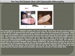 Two Year Old Diabetic Ulcer with Osteomylitis &Neuropathy
The photograph is of a diabetic patient, his name was Mr. Amrit Roy He felt some swelling
on his left foot. He ignored this and applied some ‘iodex’ for the treatment of swelling. After
one week the swelling increased and he noticed some pus coming out of the fingers of his
feet. He immediately consulted his family doctor who mercilessly performed surgery on his
foot. This made the wound even worse. He had his x-ray done and found that he had
developed osteomylitis(bone infection) with nuropathy(no sensation in feet). His infection
could not be controlled despite heavy doses antibiotics. He was then advised to go in for
amputation by all surgeons treating him as that was urgently required. He did not want that.
So he consulted one doctor who advised him for the oil. He started applying the oil and
found that his wound healed and sensation returned to normal in a few weeks time.
 