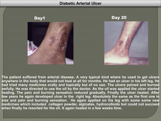 Diabetic Arterial Ulcer
Day1 Day 20
The patient suffered from arterial disease. A very typical kind where he used to get ulcers
anywhere in the body that would not heal at all for months. He had an ulcer in his left leg. He
had tried many medicines orally and topically but of no use. The ulcers pained and burned
awfully. He was directed to use the oil by the doctor. As the oil was applied the ulcer started
healing. The pain and burning sensation reduced gradually. Finally the ulcer healed. After
few years he again developed ulcer in the right leg. Absolutely the same as the first one in
size and pain and burning sensation. He again applied on his leg with some some new
medicines which included collagen powder, alginates, hydrocolloids but could not succeed
when finally he resorted for the oil. It again healed in a few weeks time.
 