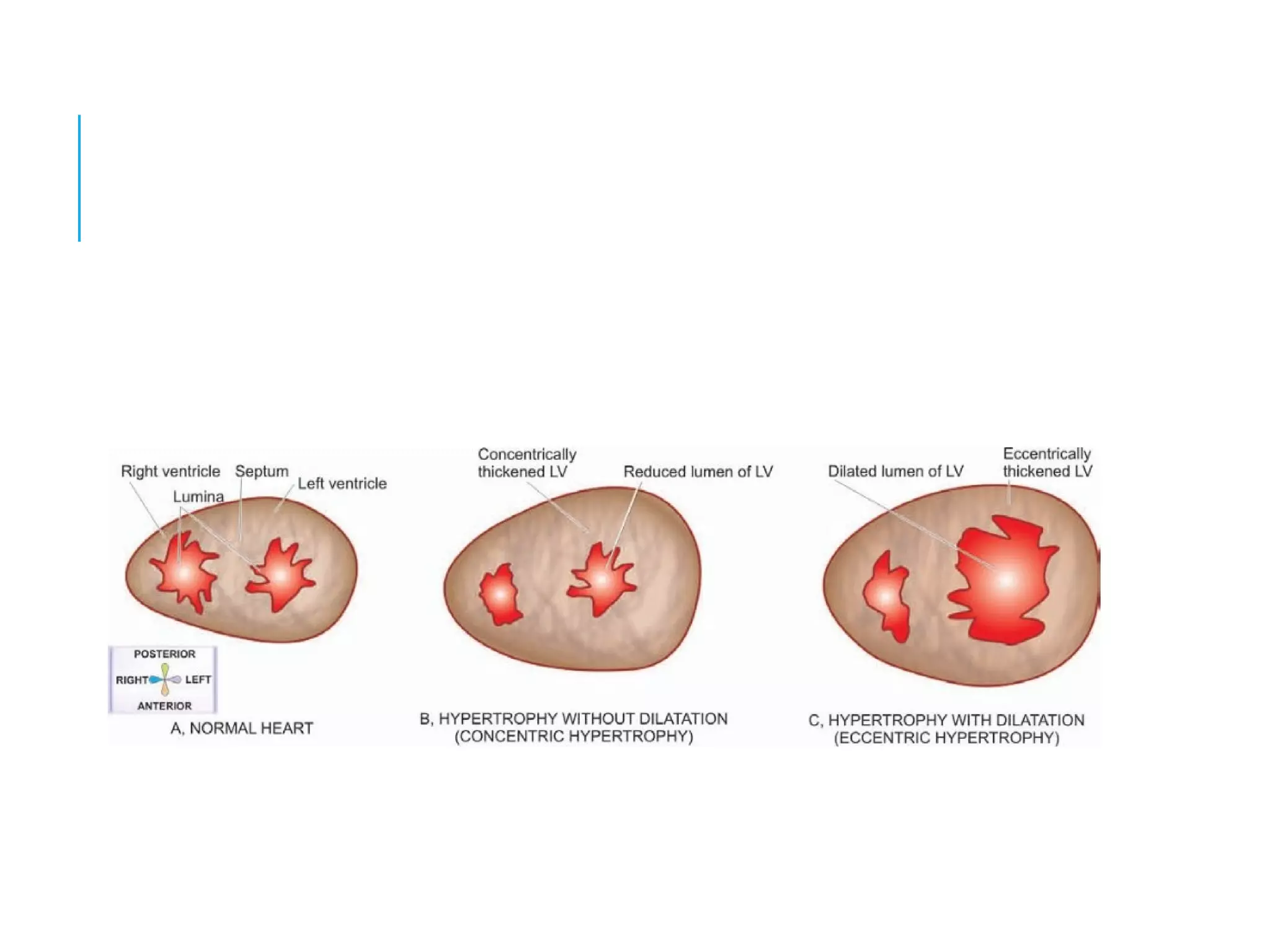 Pathophysiology of Heart failure
