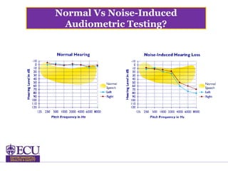 Normal Vs Noise-Induced
Audiometric Testing?
 