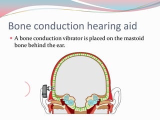 Bone conduction hearing aid
 A bone conduction vibrator is placed on the mastoid

bone behind the ear.

 