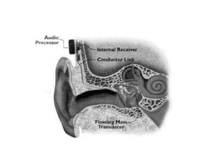 Hearing aids and cochlear implants.pptx