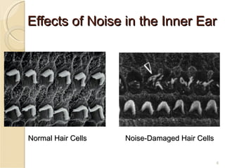 Effects of Noise in the Inner Ear Normal Hair Cells Noise-Damaged Hair Cells 