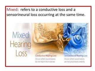 Mixed: refers to a conductive loss and a
sensorineural loss occurring at the same time.
 