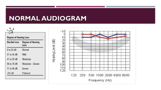 NORMAL AUDIOGRAMNORMAL AUDIOGRAM
 