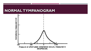 NORMALTYMPANOGRAMNORMALTYMPANOGRAM
 