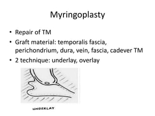 Myringoplasty
• Repair of TM
• Graft material: temporalis fascia,
perichondrium, dura, vein, fascia, cadever TM
• 2 technique: underlay, overlay
 