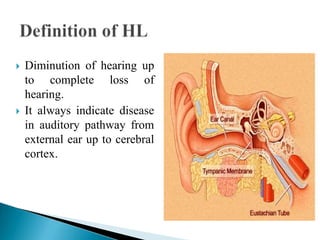 Hearing loss.pptx