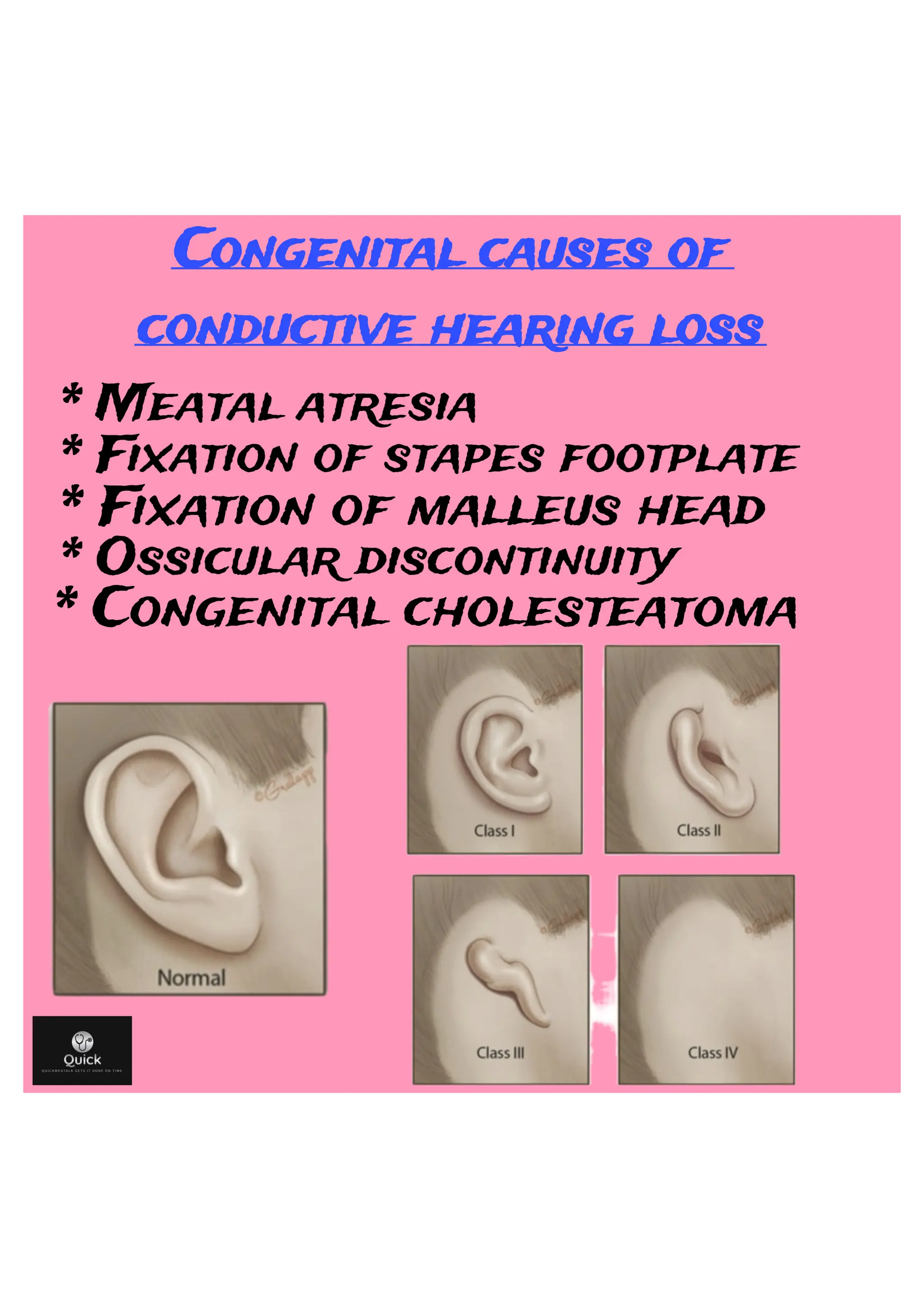 Hearing Loss Pdf Ent By Quickmedtalk Pdf