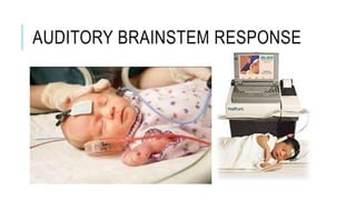 AUDITORY BRAINSTEM RESPONSE
 