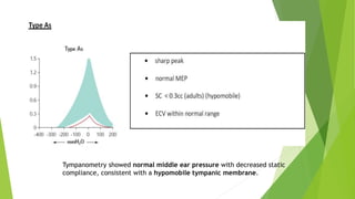 Tympanometry showed normal middle ear pressure with decreased static
compliance, consistent with a hypomobile tympanic membrane.
 