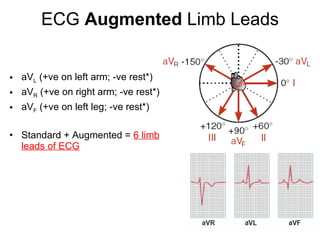 ECG  Augmented  Limb Leads aV L  (+ve on left arm; -ve rest*) aV R  (+ve on right arm; -ve rest*) aV F  (+ve on left leg; -ve rest*) Standard + Augmented =  6 limb leads of ECG 