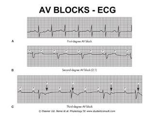 AV BLOCKS - ECG 