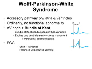 Wolff-Parkinson-White Syndrome   Accessory pathway b/w atria & ventricles Ordinarily, no functional abnormality  AV node +  Bundle of Kent Bundle of Kent conducts faster than AV node Excites one ventricle early – circus movement Paroxysmal atrial tachycardia  ECG Short P-R interval Prolonged QRS (slurred upstroke) 