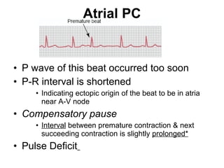 Atrial PC P wave of this beat occurred too soon P-R interval is shortened Indicating ectopic origin of the beat to be in atria near A-V node Compensatory pause Interval  between premature contraction & next succeeding contraction is slightly  prolonged* Pulse Deficit   